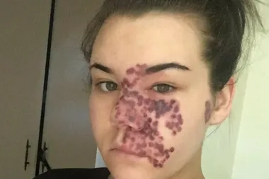 Transformation – birthmark that covered half of teen’s face is removed