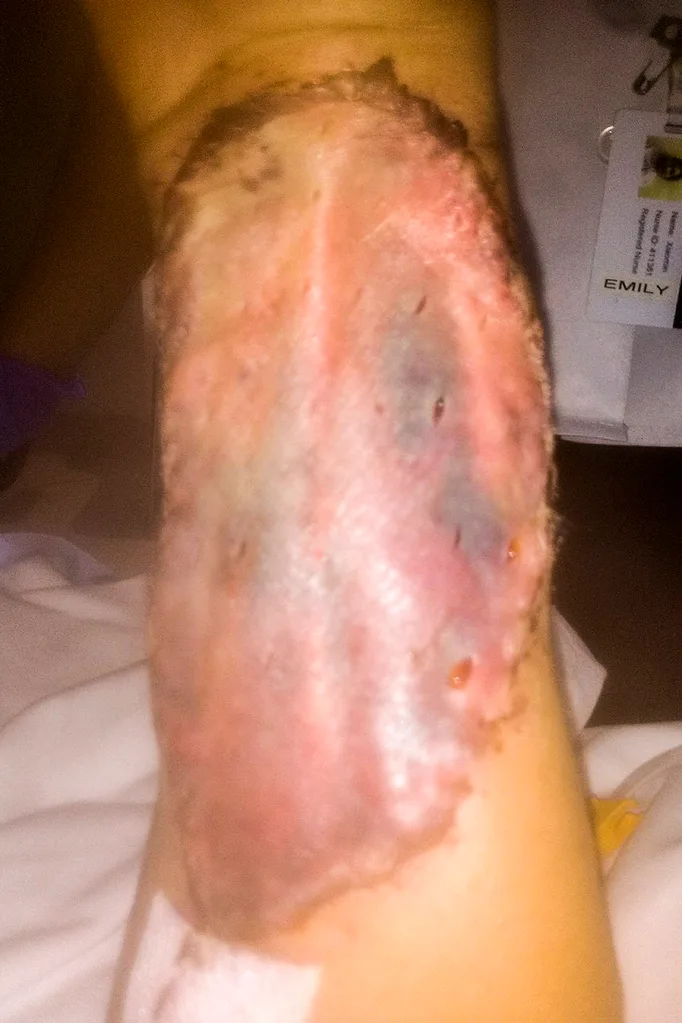 skin graft