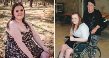 Burn survivor’s courage: ‘My scars don’t define me’