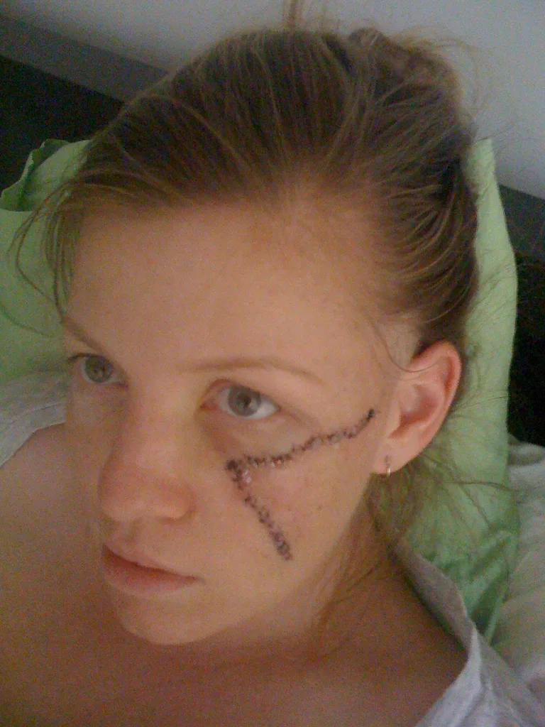 I needed around 200 stitches.
