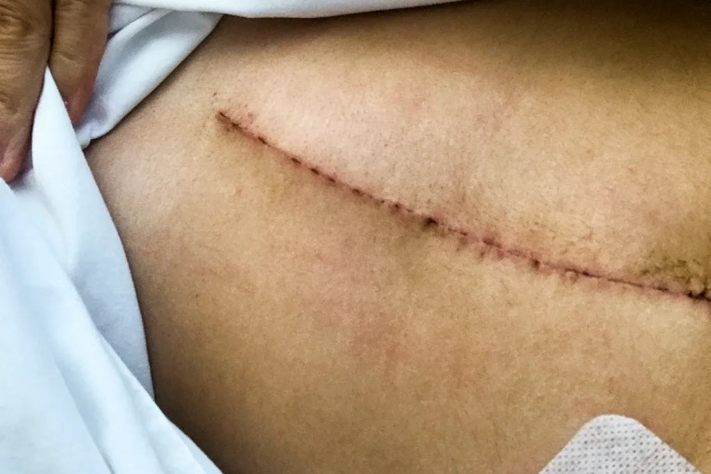 My incision scar