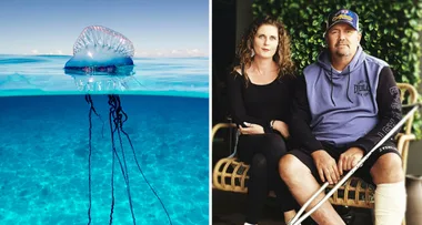 A bluebottle nearly took my leg: my amputation nightmare!