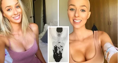 24-year-old tells: ‘My mystery pain was cancer’