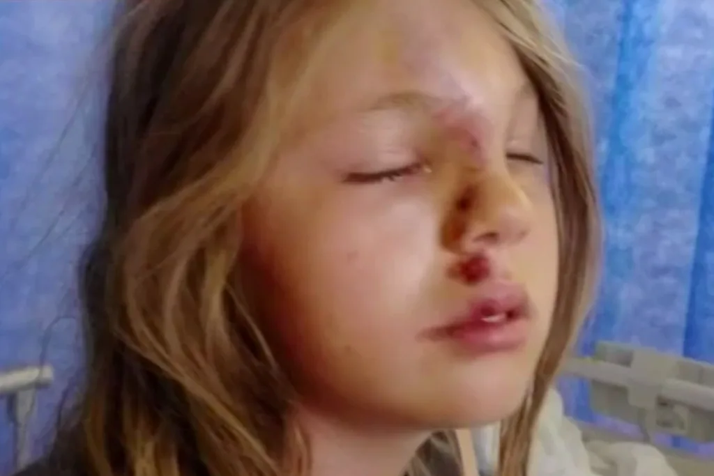Alannah had facial injuries and skull fractures