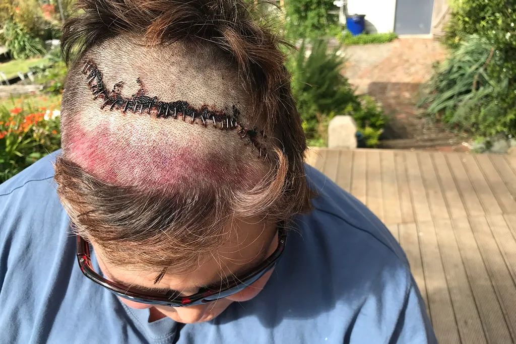 staples in my scalp