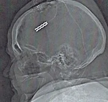xray scan