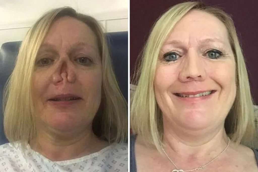 Jayne with and without her prosthetic nose