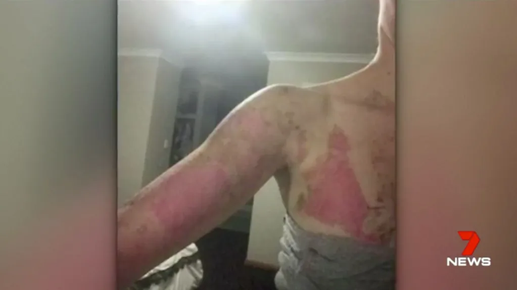 burns 1