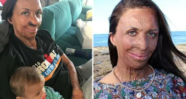 Turia Pitt reveals results of ‘nose reconstruction’