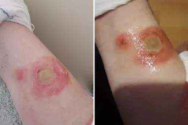 Horrifying new craze leaving teens with second-degree burns