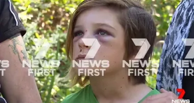 Young boy ‘breaks every bone in his face’ after scooter trick goes wrong