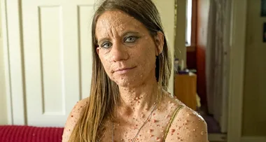 Mum covered in 6000 tumours receives life-saving treatment – you should see her now!