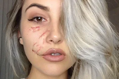 Model Suzel Mackintosh scarred for life after dog attack