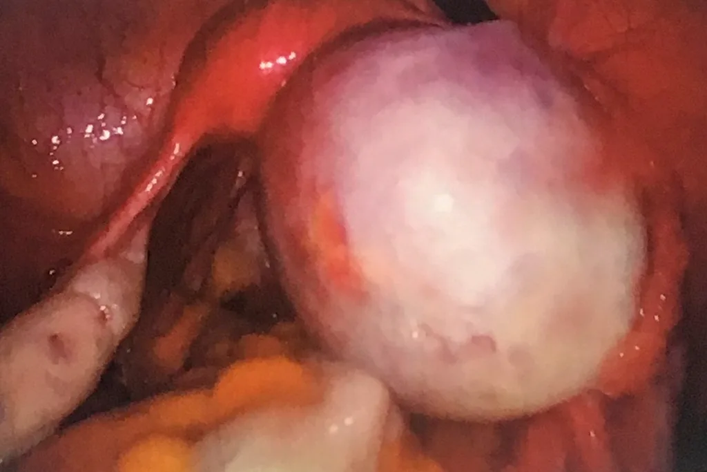 cyst