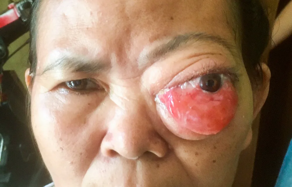 Fitiria’s eye bulged out of the socket