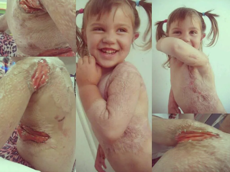 scarring
