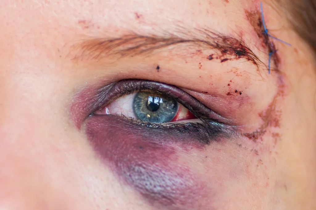 badly injured