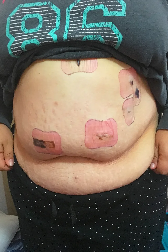after surgery