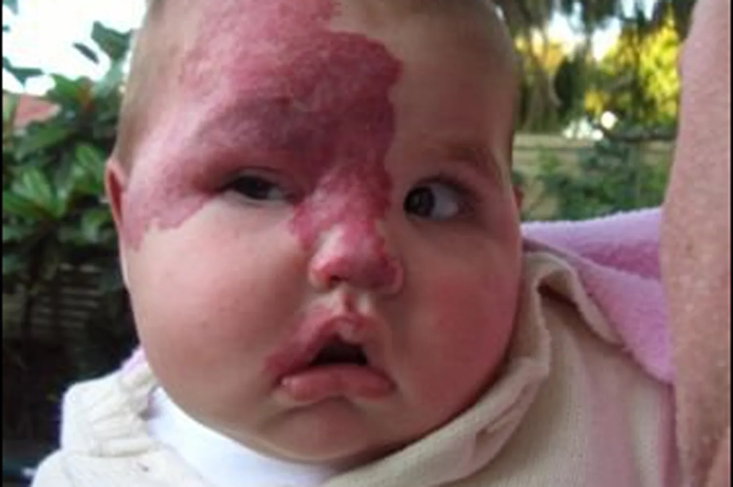 The birthmark spread across her face
