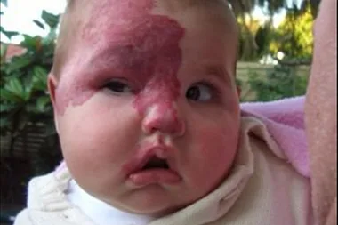 The birthmark spread across her face