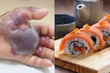 Man has arm AMPUTATED after eating sushi