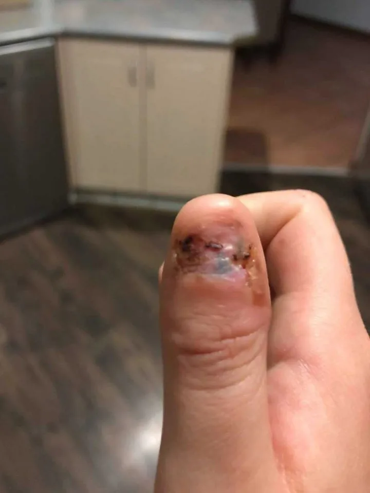 She has now had her thumb amputated