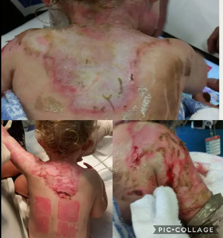 third degree burns