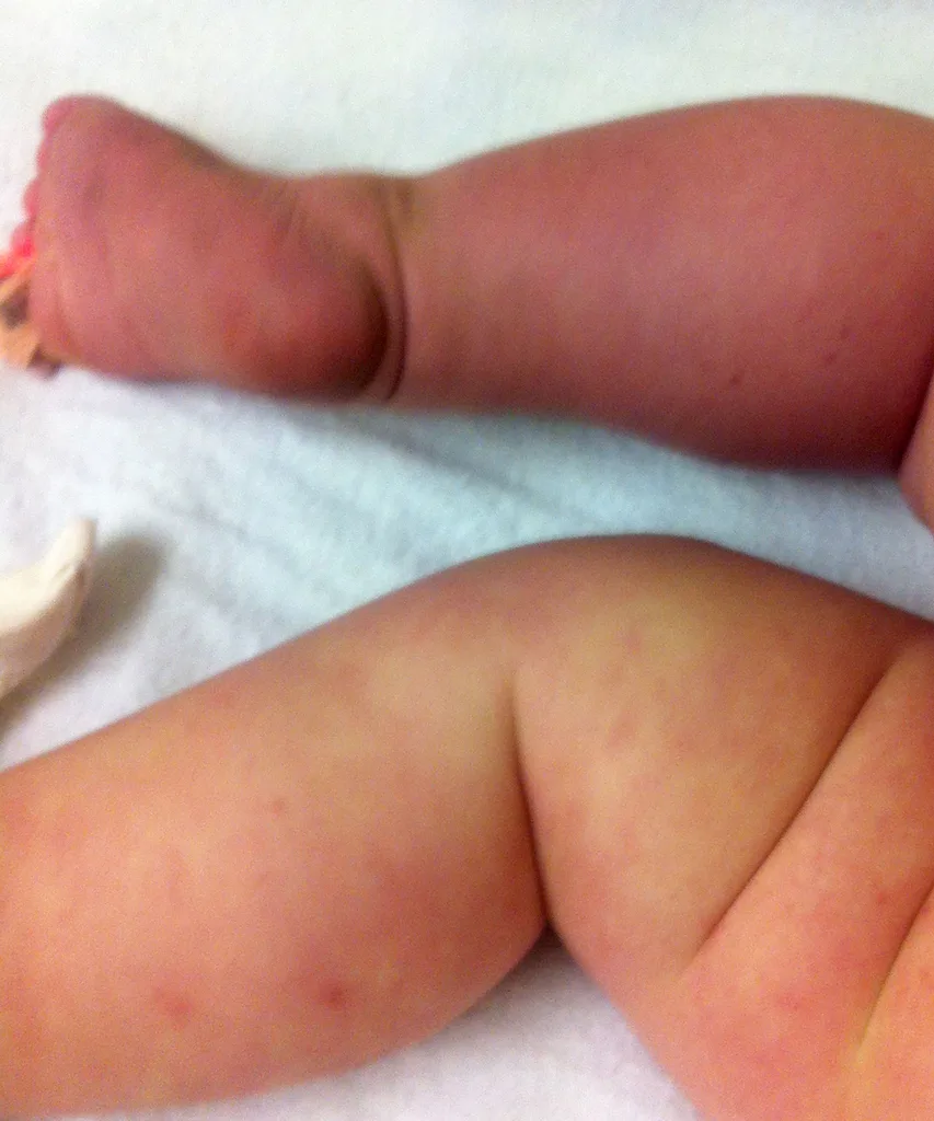 Layton's leg