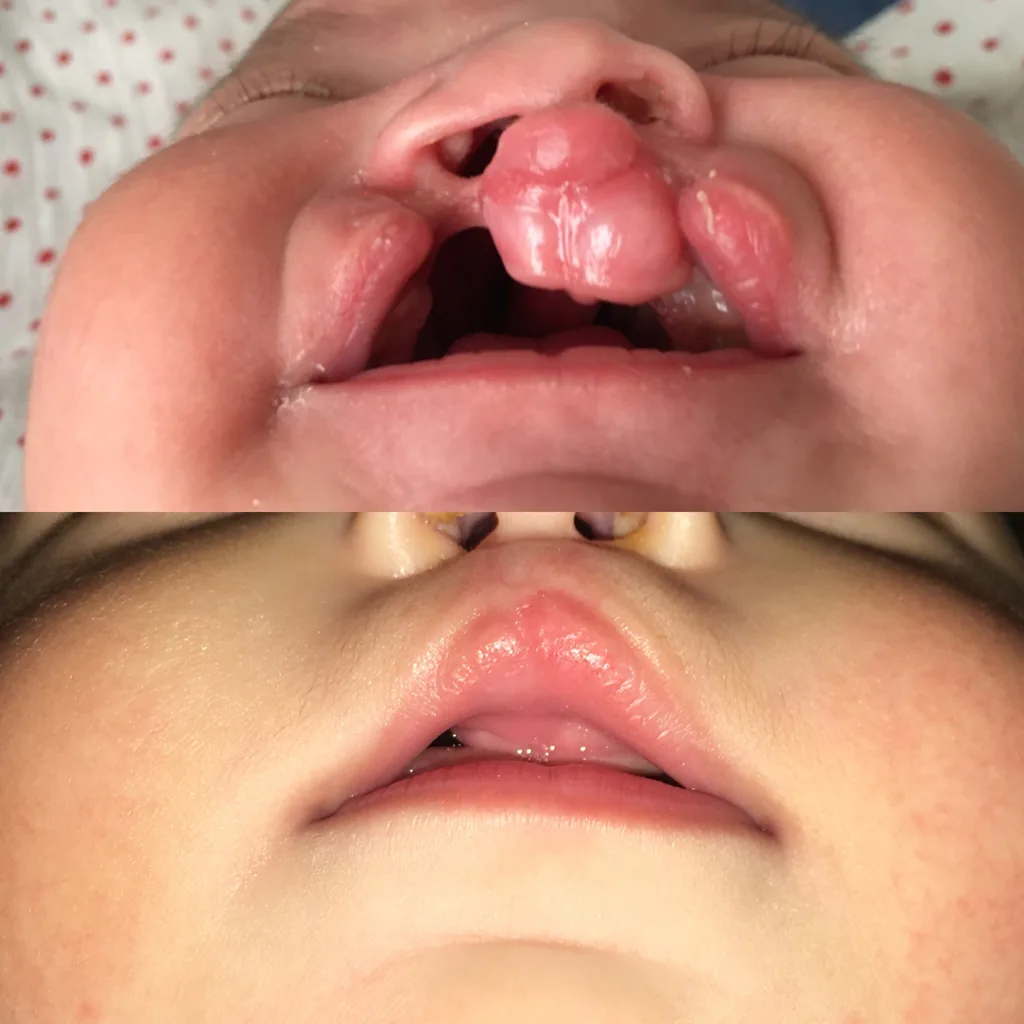before and after