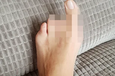 Nurse begs doctors to cut off leg after years of excruciating pain caused by routine toe operation