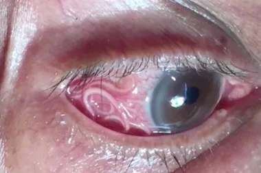 Shocking moment a 15cm tape worm is pulled from a man’s eye