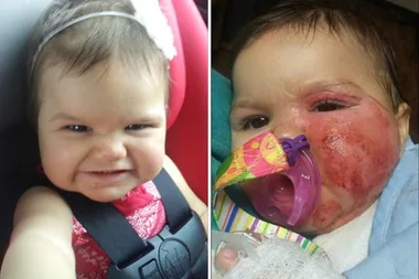 Baby girl BURNED by a slow cooker
