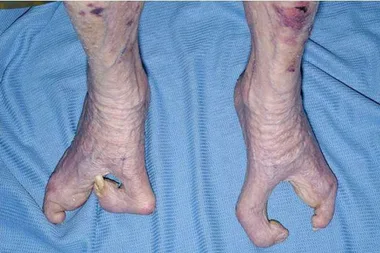 Grandmother, 94, found to have rare ‘lobster claw’ feet