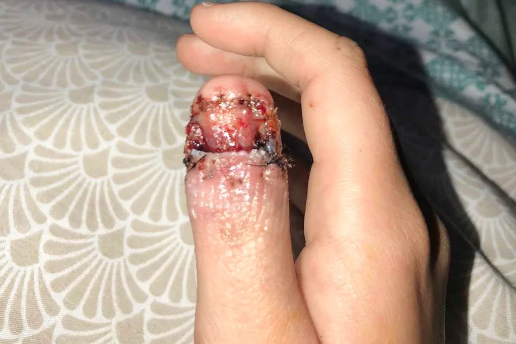 nail biting