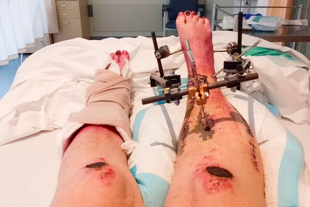 leg damage
