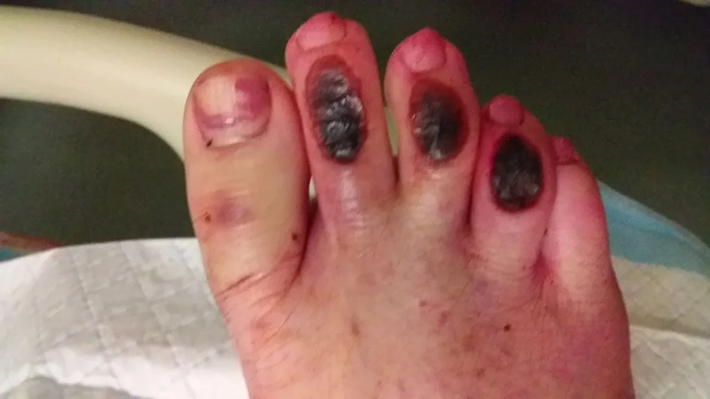toe