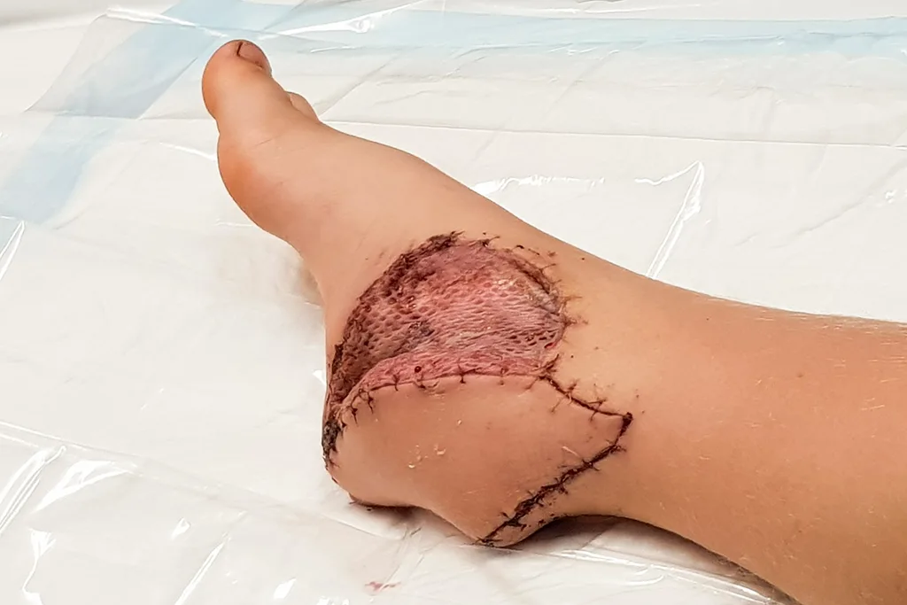 skin graft