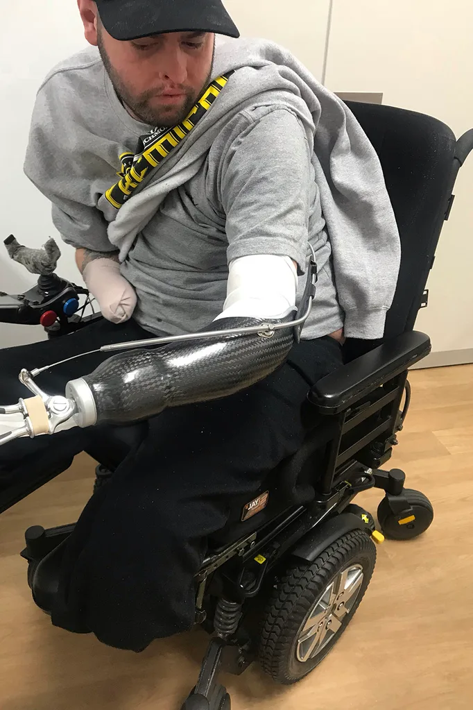 prosthetic