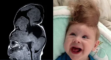 Born with his brain outside his skull