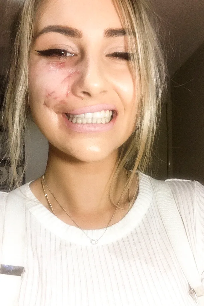 I’ve got nerve damage in my lip and nose