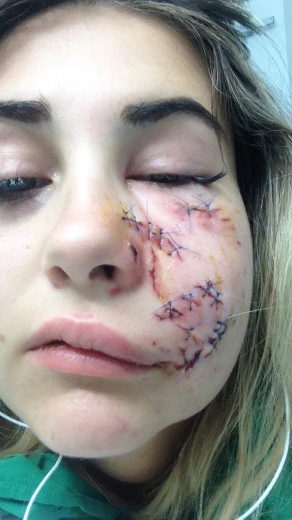stitches