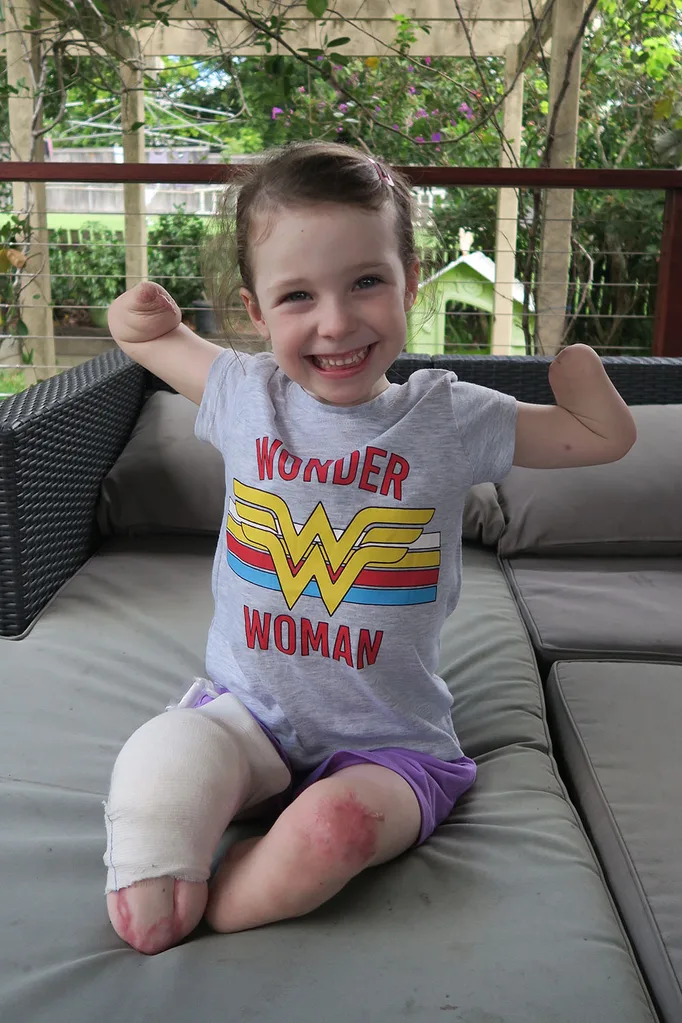 limb loss