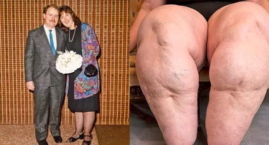 I lost my legs to lipoedema