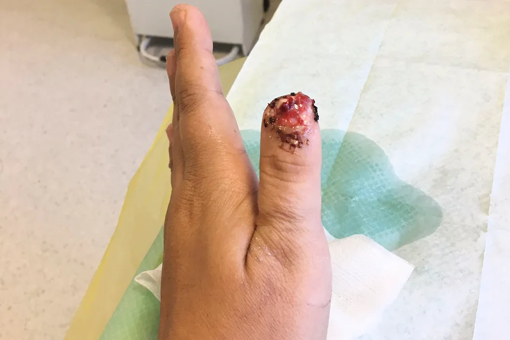 thumb bitten