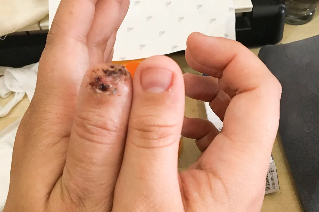 healing thumb