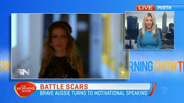 Brave burns victim Dana Vulin shares her remarkable story