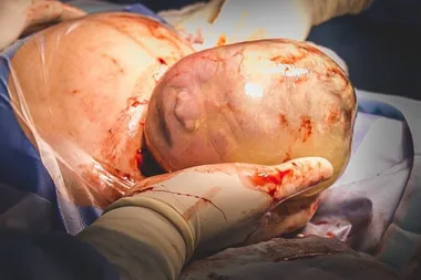 Incredible images show rare one in 100,000 birth