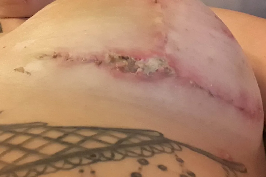 scars