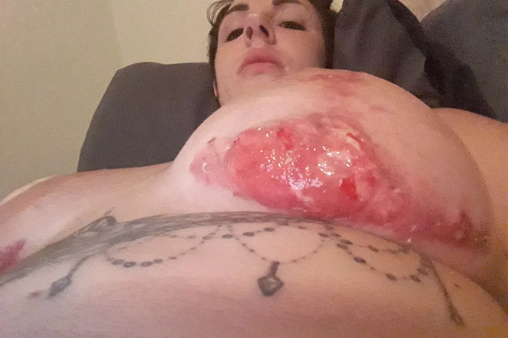 wound