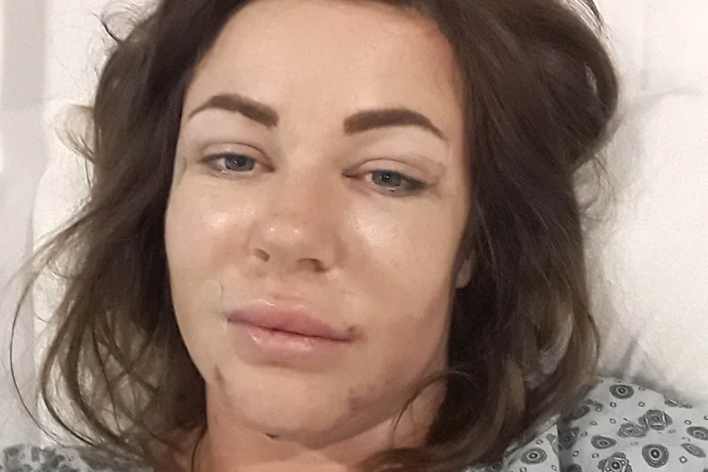 after surgery